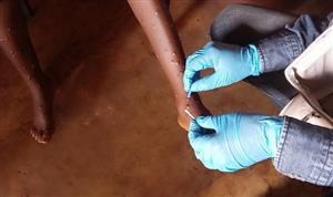 WHO approves first mpox diagnostic test for emergency use, boosting global access